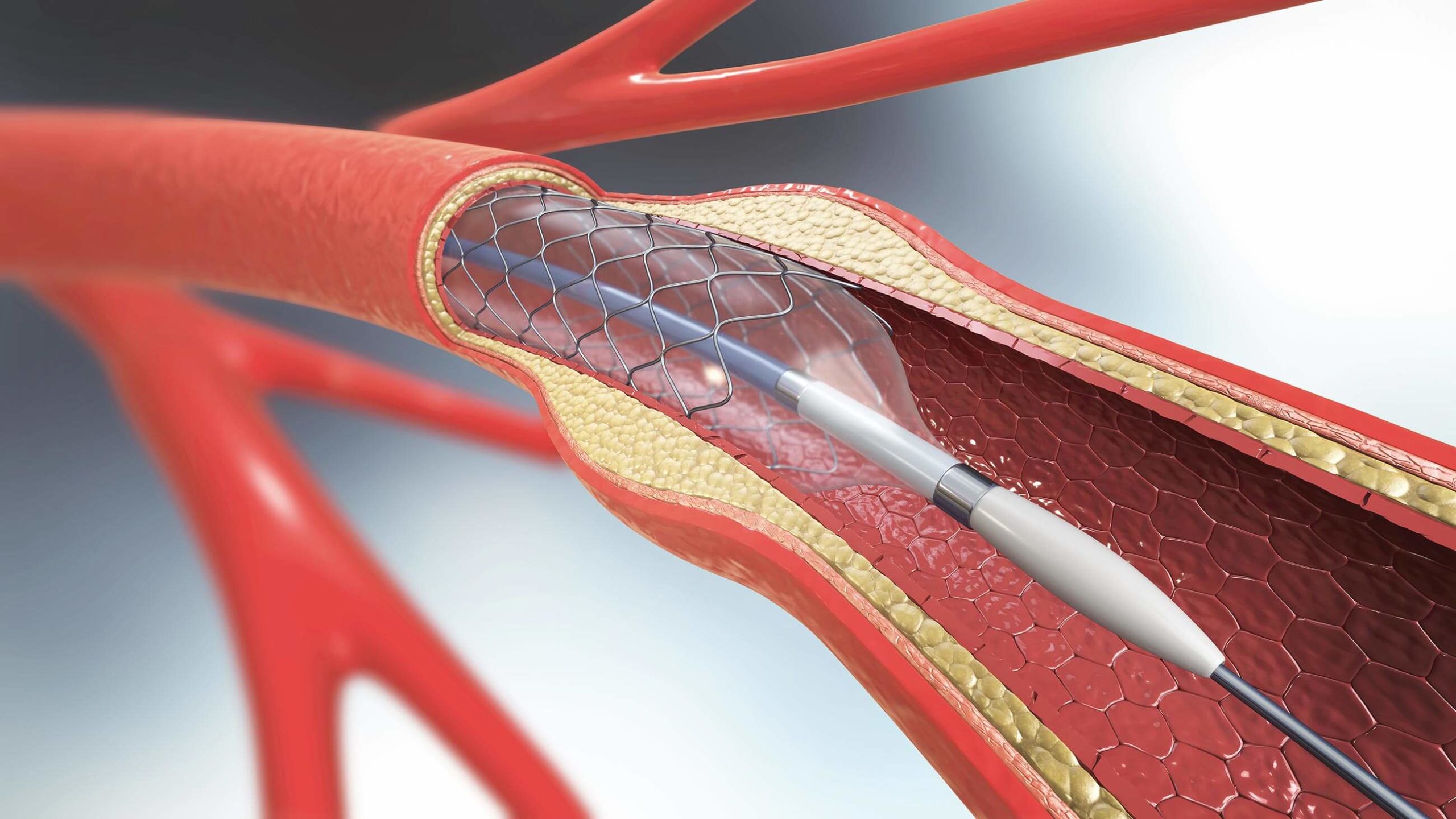 Stent Placement