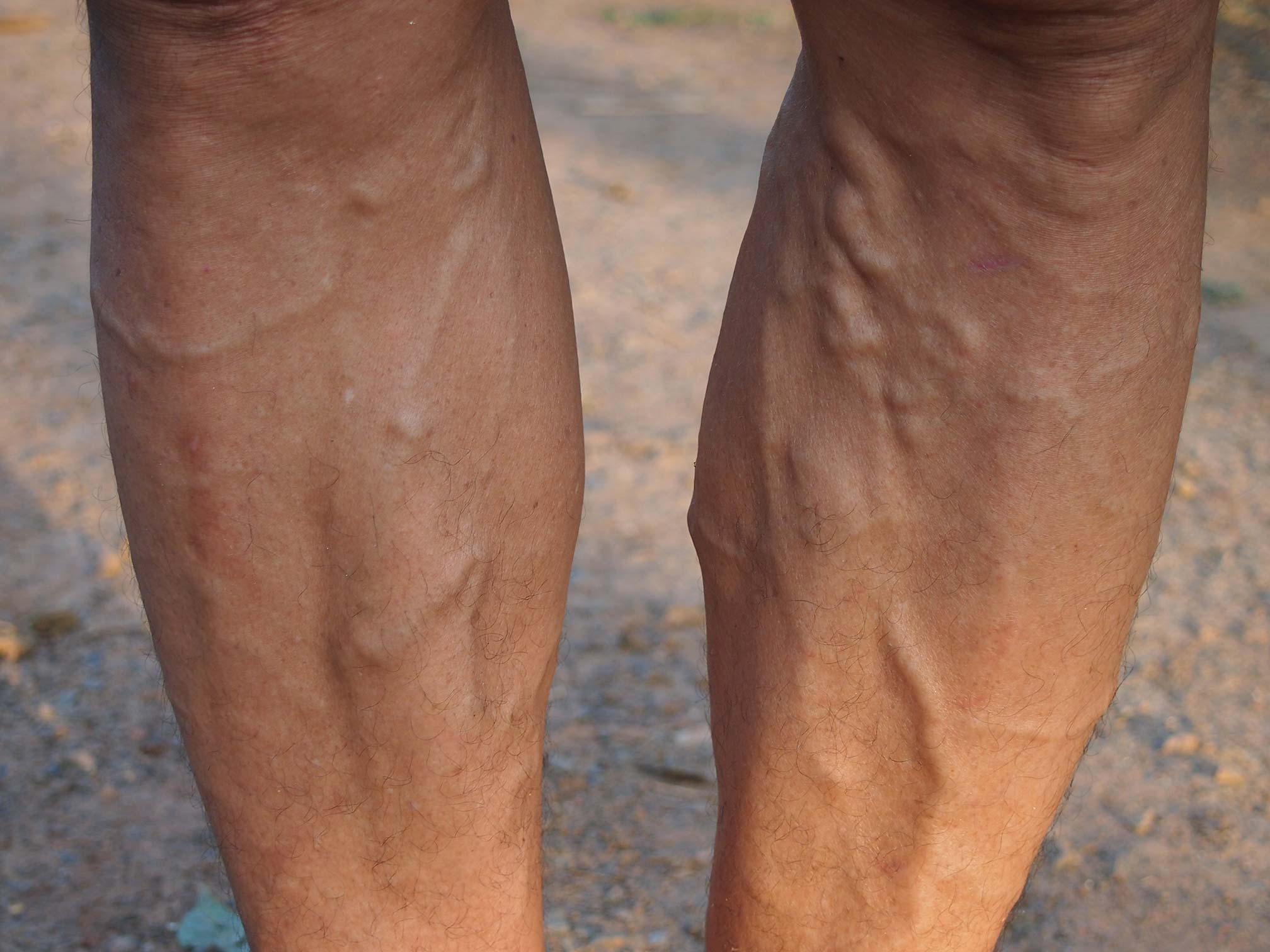 Venous Insufficiency Julio Sanguily III, MD